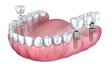 Teeth Replacement