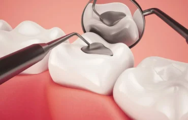 Restorations (Dental Fillings)