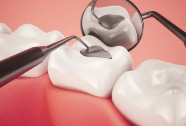 Restorations (Dental Fillings)