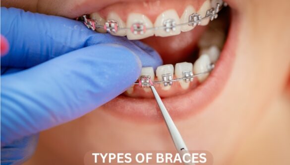 Exploring the Different Types of Braces