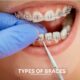 Exploring the Different Types of Braces