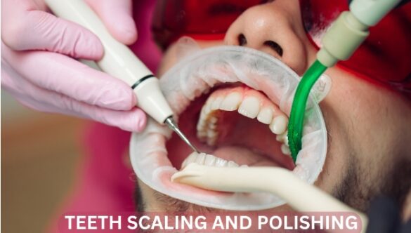 The Benefits of Teeth Scaling and Polishing