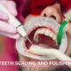 The Benefits of Teeth Scaling and Polishing