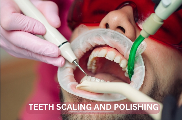 The Benefits of Teeth Scaling and Polishing