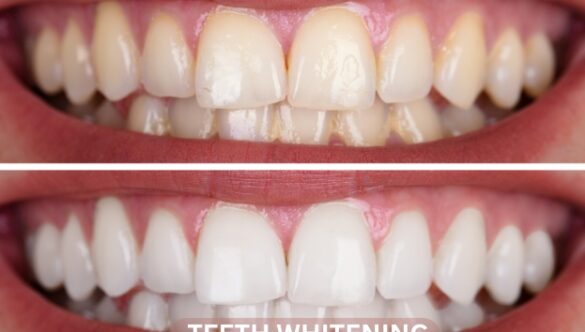 The Best Teeth Whitening Treatments of 2024