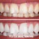 The Best Teeth Whitening Treatments of 2024