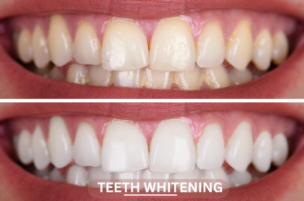The Best Teeth Whitening Treatments of 2024