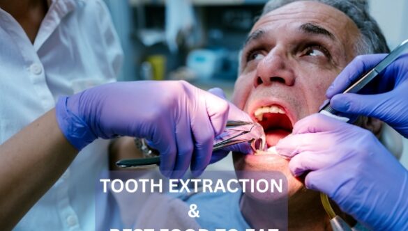 Best Foods to Eat After a Tooth Extraction: Discovering the Foods to Eat After Extraction